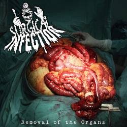 Surgical Infection : Removal of the Organs